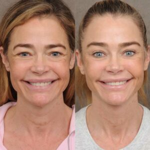 Denise-Richards-estiramiento-facial
