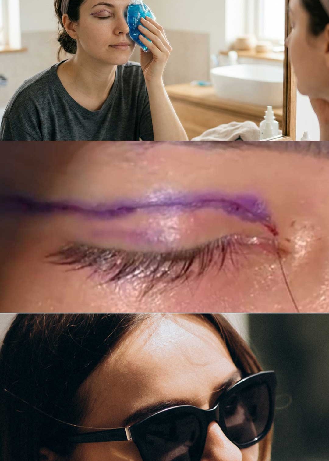 recuperación blefaroplastia