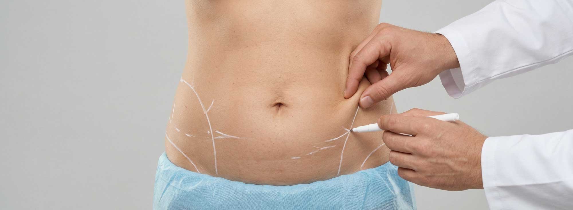 Precio-de-una-liposucción