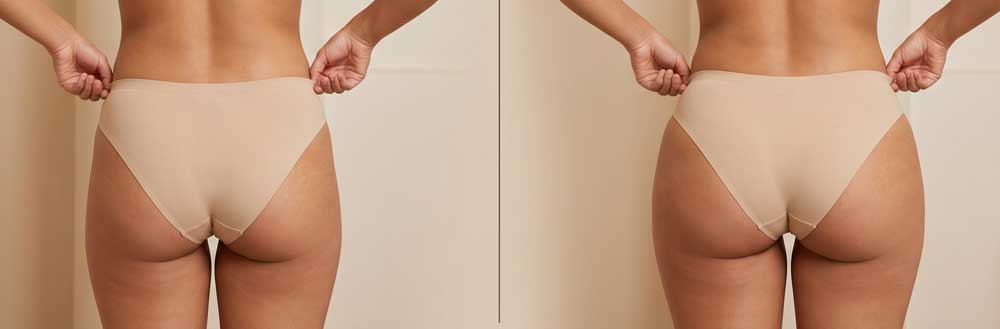 Qué-cambia-realmente-en-tu-cuerpo-con-un-BBL