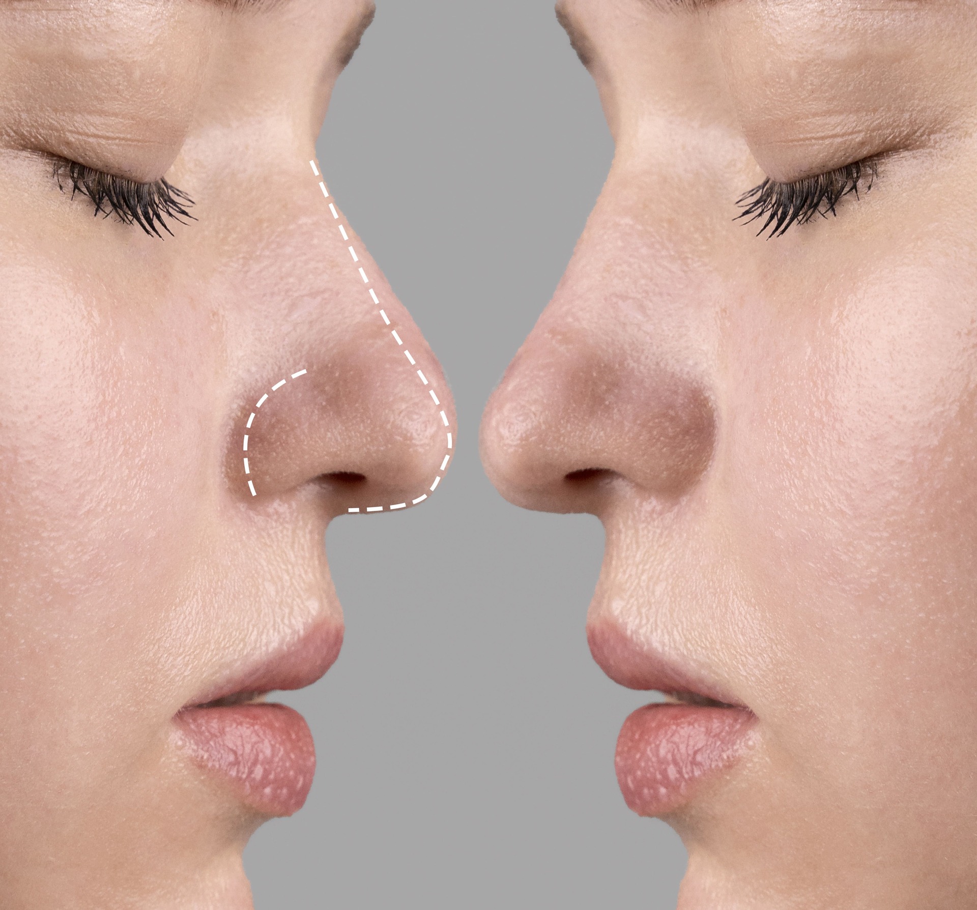 Cuánto dura una rinomodelación con ácido hialurónico