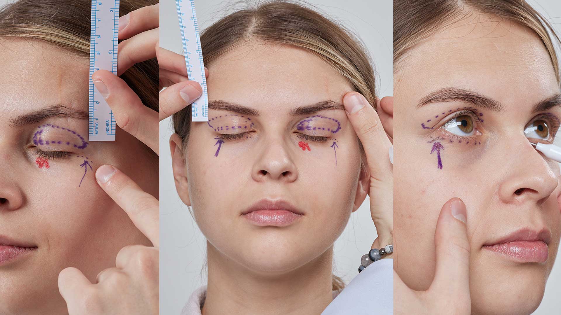 Recuperación de una blefaroplastia