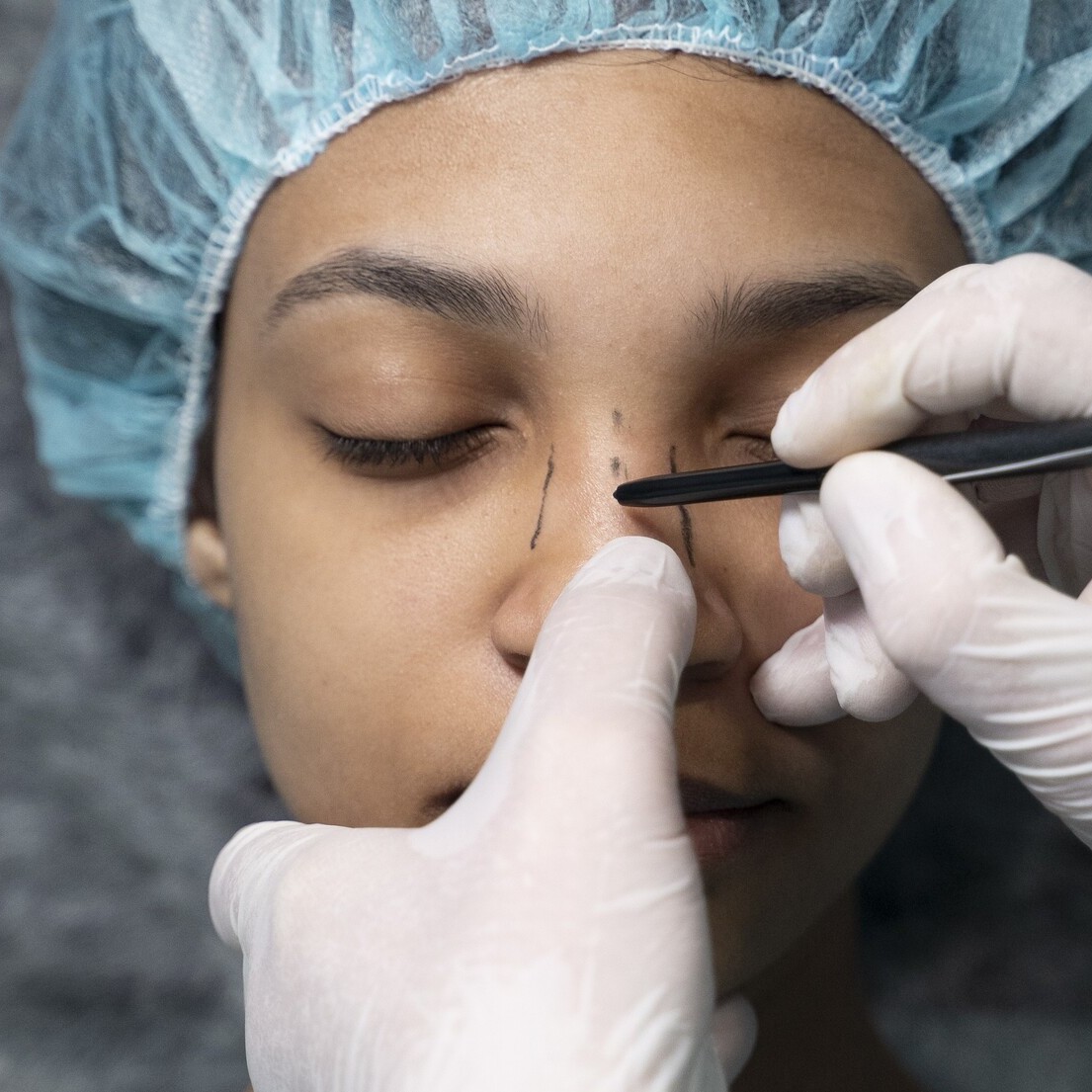 Cuándo conviene valorar una rinoplastia