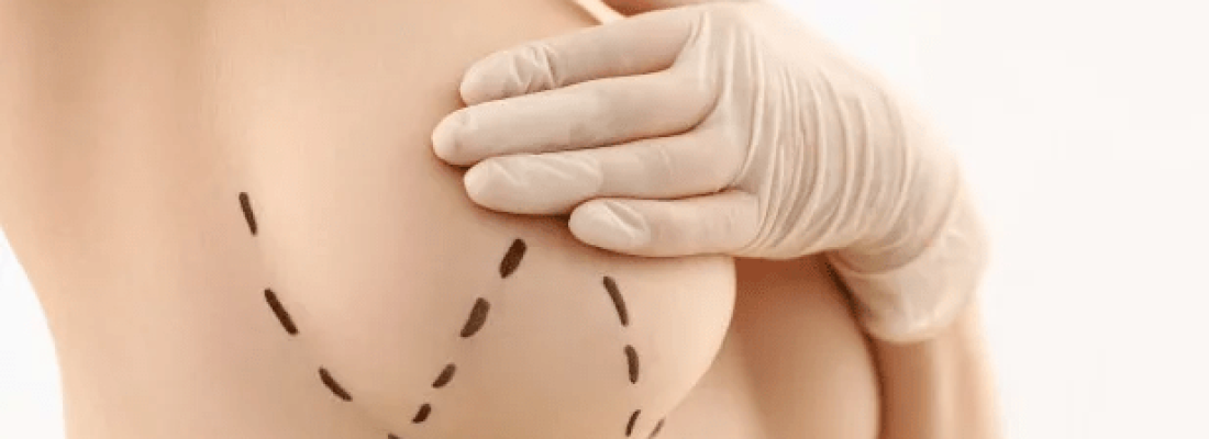 Lifting des seins à Barcelone