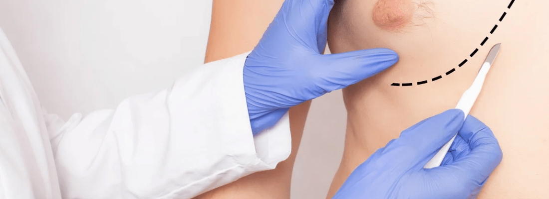 ginecomàstia barcelona