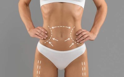 Liposuccion cuanto cuesta