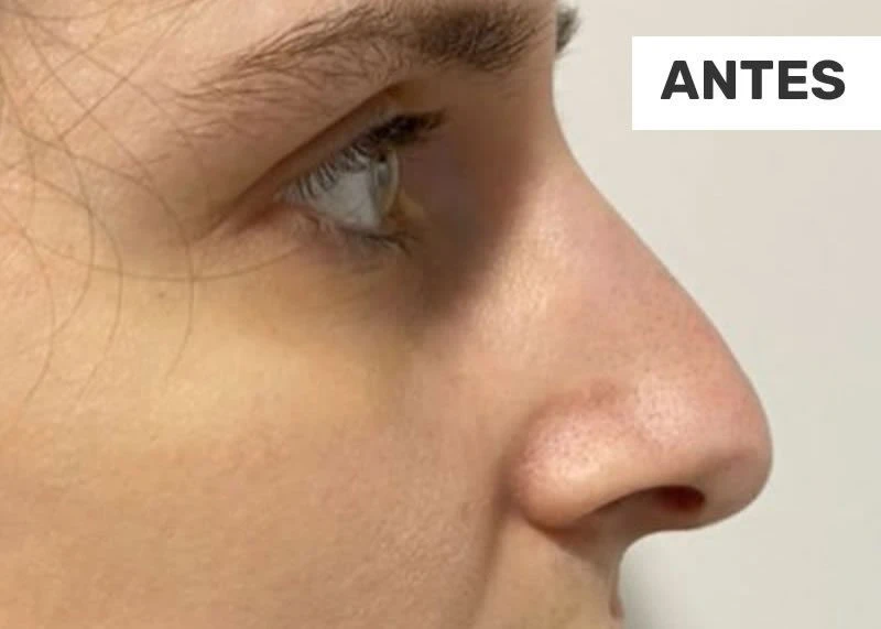 1-facial-antes
