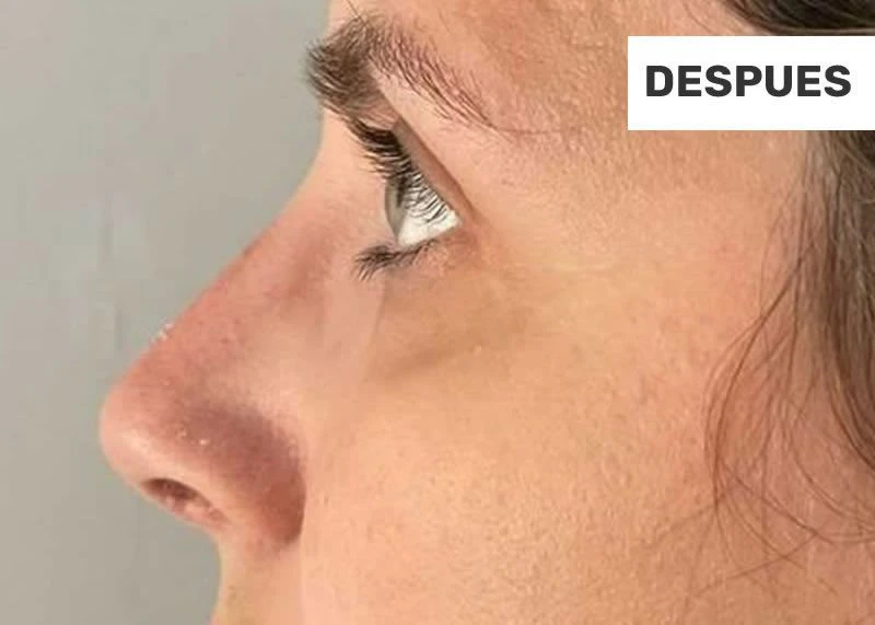 1-facial-despues