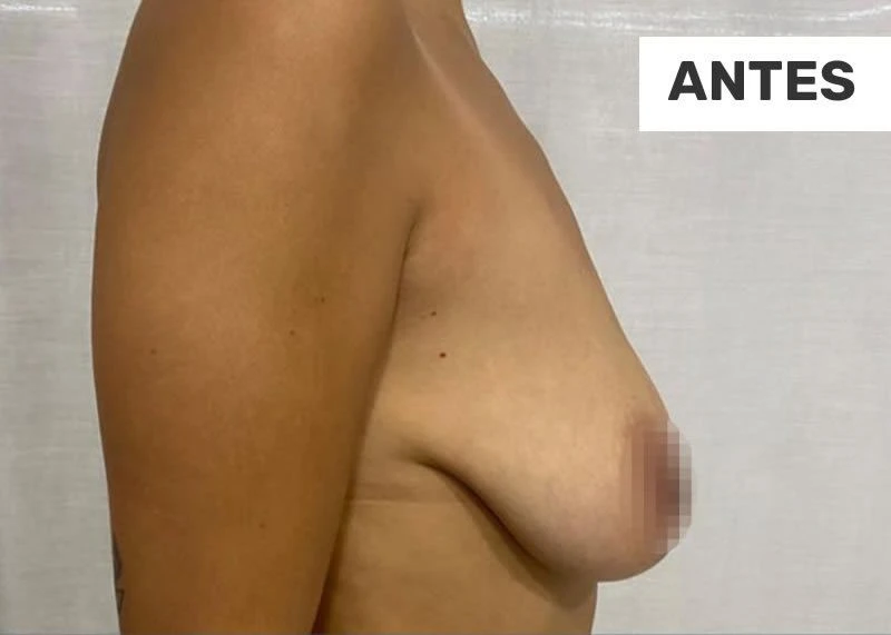 3-elevacion-mamas-antes