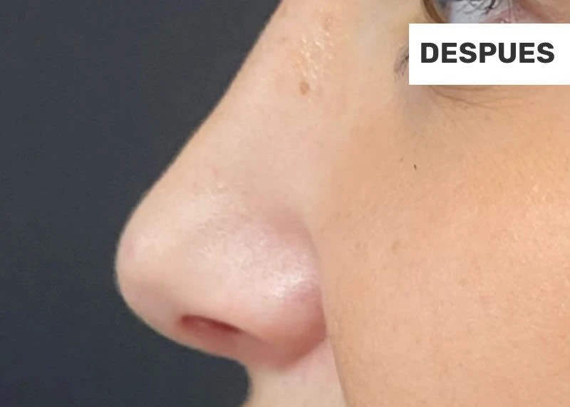 3-facial-despues
