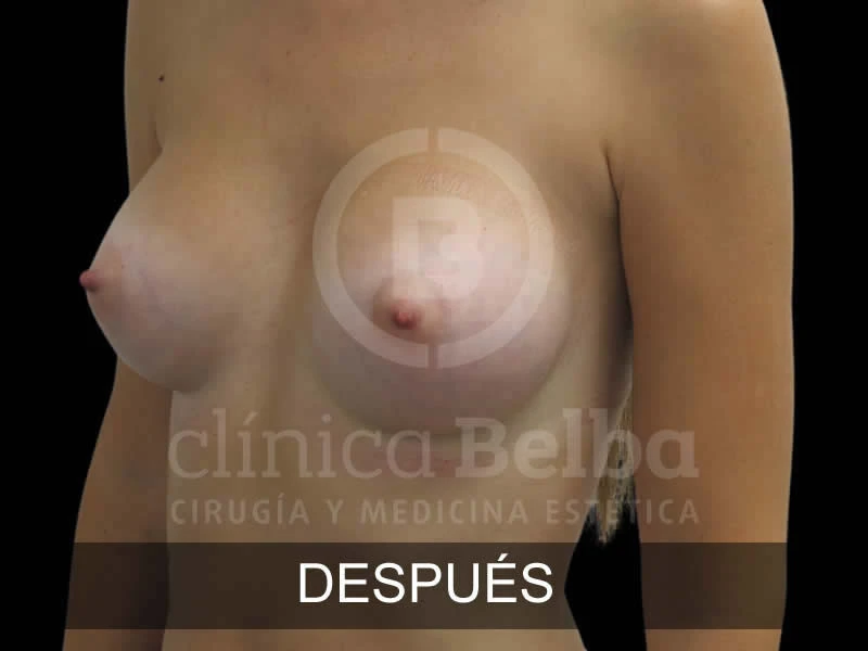 belba-aumento-armonia-1-despues