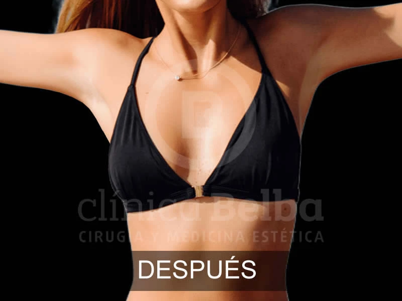 belba-aumento-armonia-10-despues-e