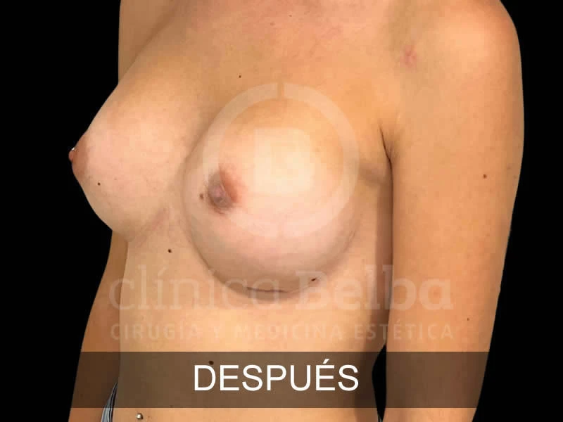 belba-aumento-armonia-10-despues