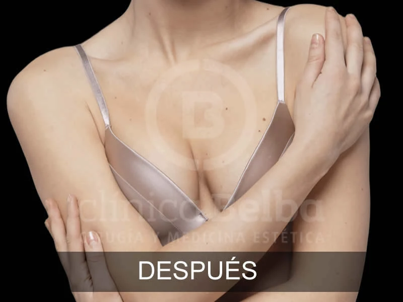 belba-aumento-armonia-11-despues-e