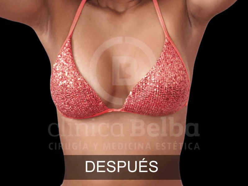 belba-aumento-armonia-12-despues-e