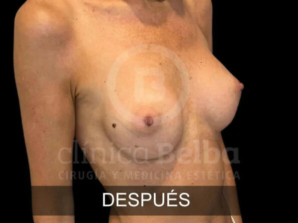 Aumento de Pecho Tecnica Brst antes y después
