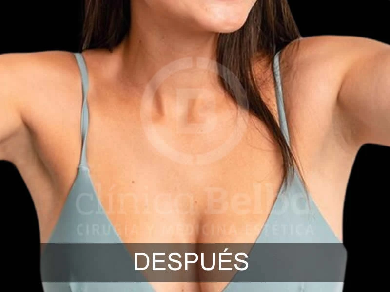 belba-aumento-armonia-4-despues-e