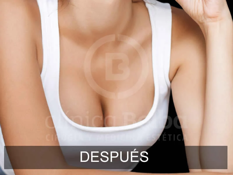 belba-aumento-armonia-5-despues-e