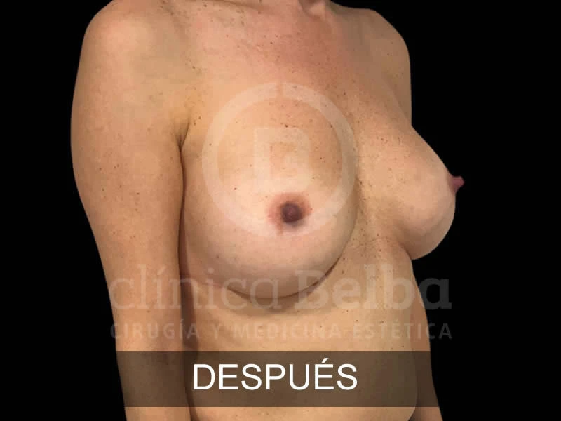 belba-aumento-armonia-5-despues