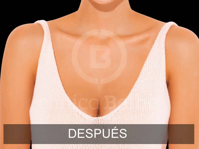 belba-aumento-armonia-6-despues-e