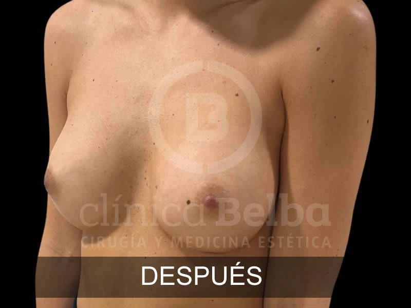 belba-aumento-armonia-8-despues