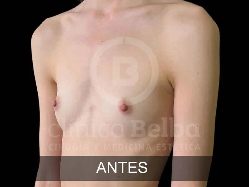 belba-aumento-armonia-9-antes