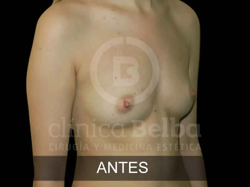 belba-aumento-elegance-1-antes