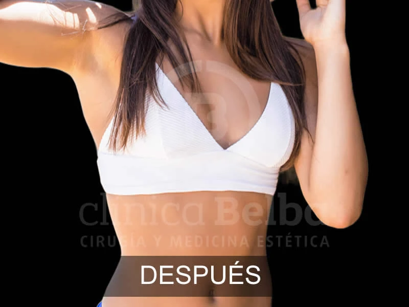 belba-aumento-elegance-2-despues-e