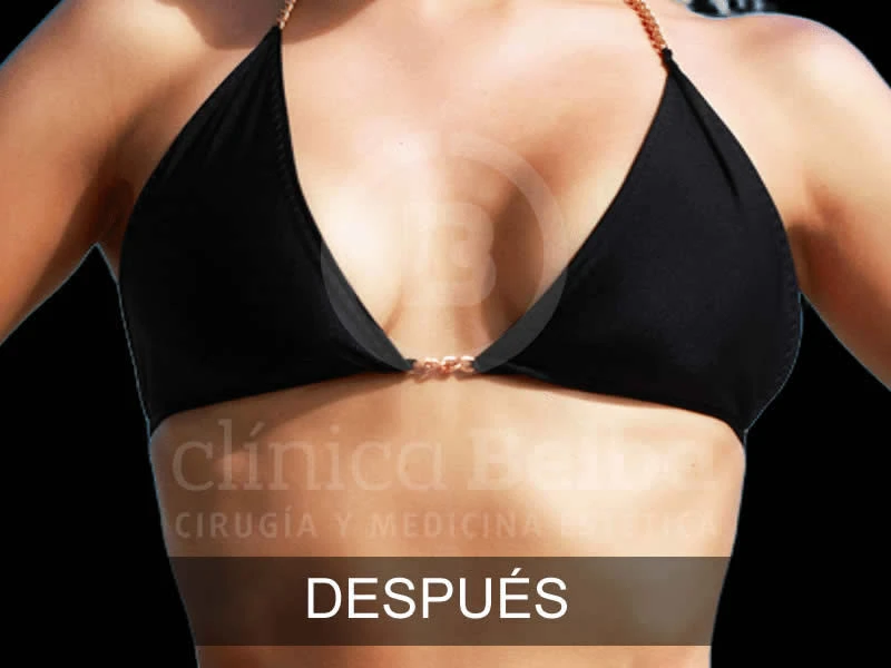 belba-aumento-elegance-4-despues-e