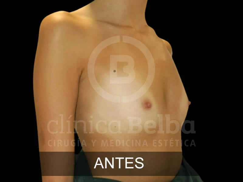 belba-aumento-elegance-6-antes