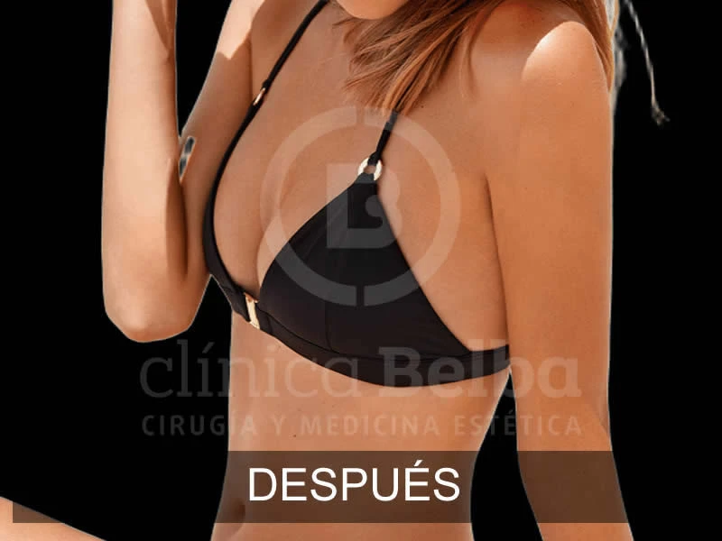 belba-aumento-elegance-8-despues-e