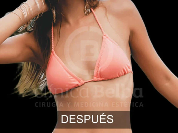 Aumento de Pecho Brst después