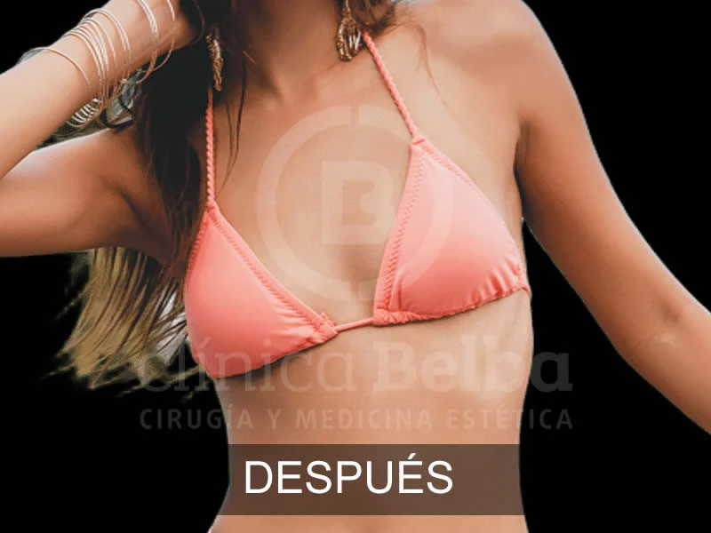 Aumento de Pecho Brst después