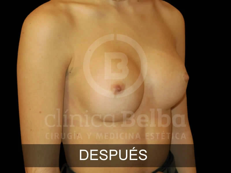 Aumento de Pecho Brst antes y después
