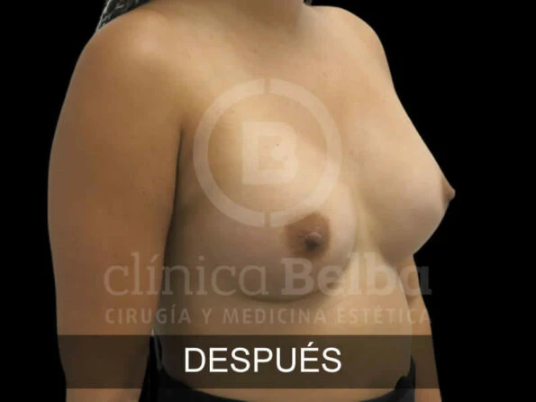 Aumento de Pecho Brst antes y después