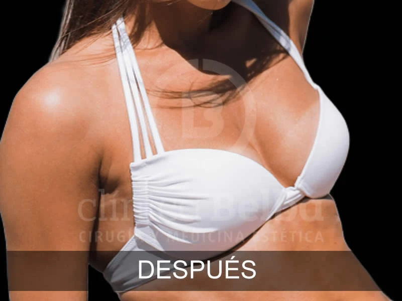 Aumento de Pecho Brst antes y después