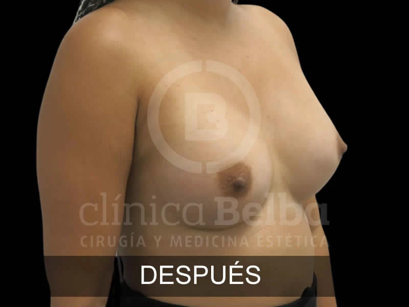 Aumento de Pecho Brst antes y después