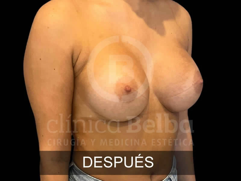 belba-aumento-sublime-2-despues
