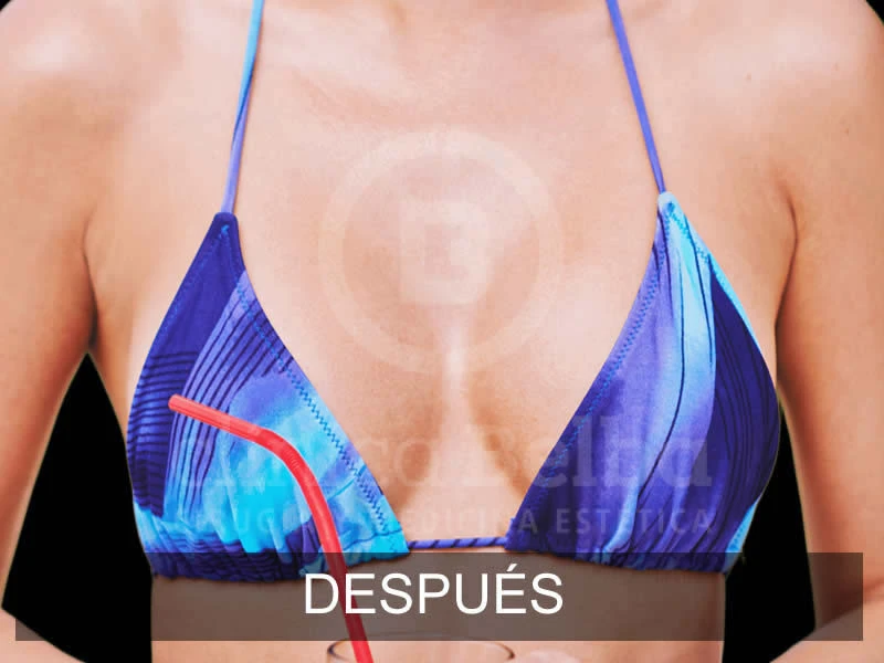 belba-aumento-sublime-3-despues-e