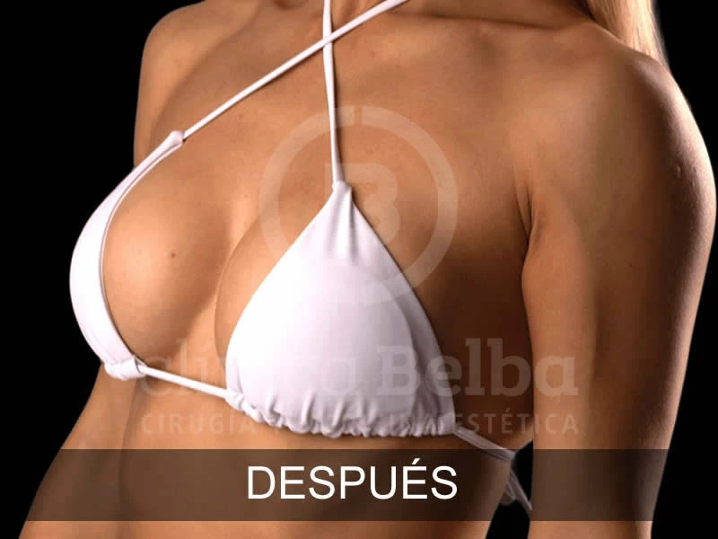 tipos de aumento de pecho