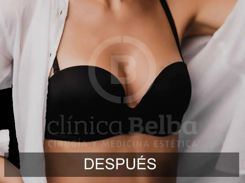 belba-augmentation-subtile-1-après-e