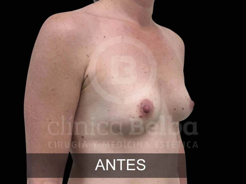 belba-augmentation-subtile-3-avant