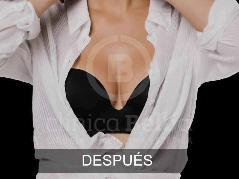 belba-augmentation-subtile-4-après-e